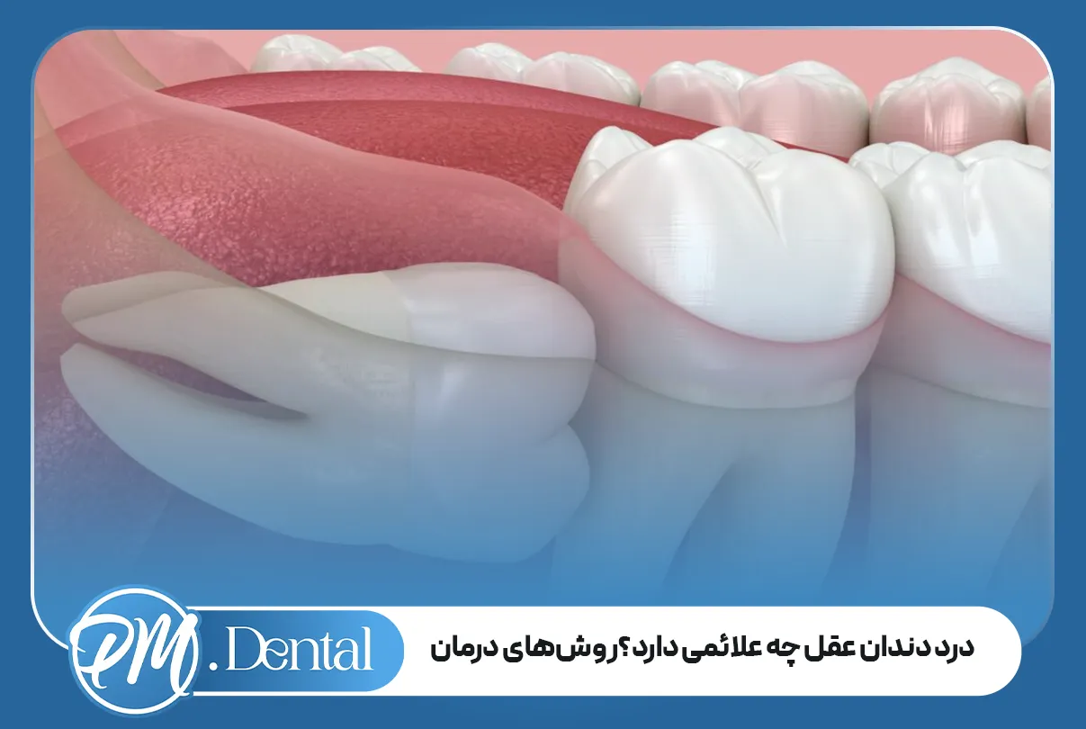 درد دندان عقل چه علائمی دارد؟ روش‌های درمان و مسکن‌ها