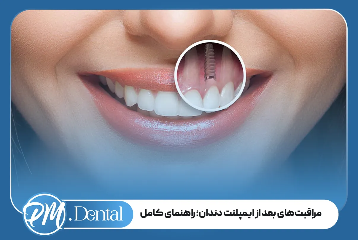 مراقبت‌های بعد از ایمپلنت دندان