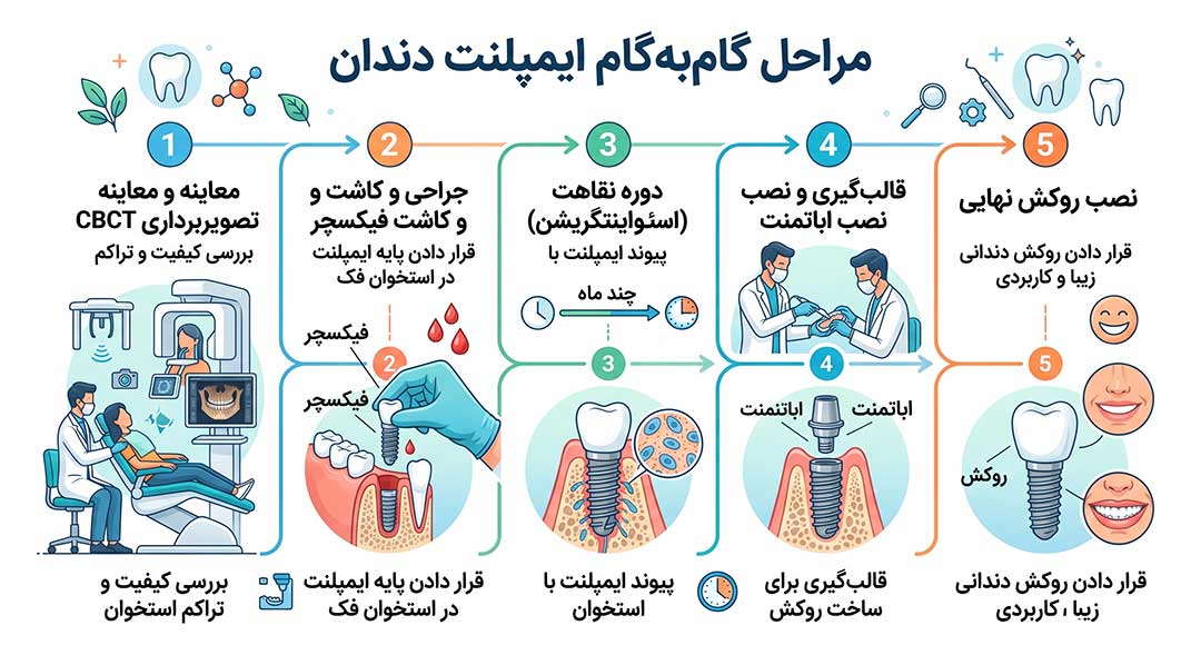 ایمپلنت دندان در فرشته