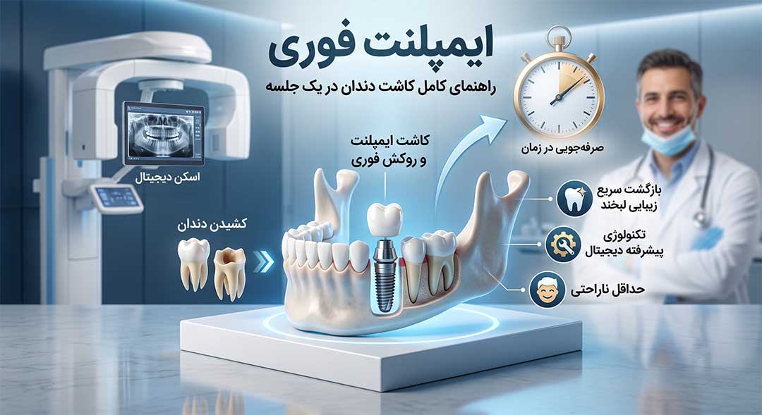 ایمپلنت فوری
